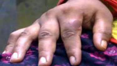 রংপুরে অজানা রোগে আক্ৰান্ত হচ্ছে মানুষ