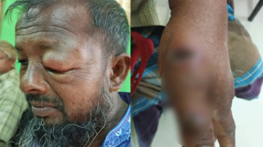 সুন্দরগঞ্জে গরু জবাইয়ের পর ১১ জনে অ্যানথ্রাক্সের উপসর্গ