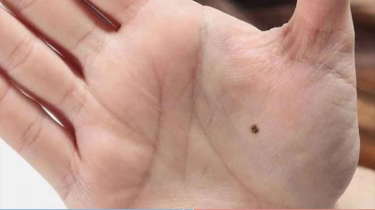 তিলের অবস্থানেই লুকিয়ে ধন-সম্পদের ইঙ্গিত তিলের অবস্থানেই লুকিয়ে ধন-সম্পদের ইঙ্গিত