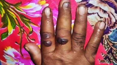 অ্যানথ্রাক্সের উপসর্গ ও প্রতিরোধের পথ