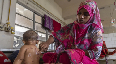 Bangladesh Cancels Leave for Health Workers Amid Measles-Linked Pneumonia Outbreak in Children