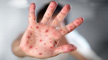 7 More Children Die with Measles Symptoms; Dhaka Division Records Highest Cases