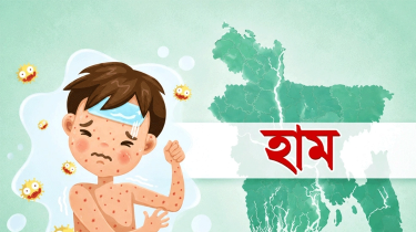 হামের উপসর্গে আরও ৬ শিশুর মৃত্যু, প্রাণহানি বেড়ে ৯০৮