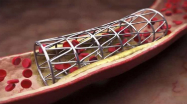 Medical Costs May Drop as VAT Removed from Heart Stents and Dialysis Equipment