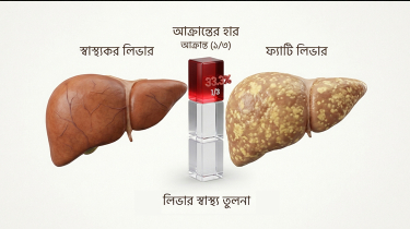 দেশে ফ্যাটি লিভারে আক্রান্ত প্রতি তিনজনে একজন দেশে ফ্যাটি লিভারে আক্রান্ত প্রতি তিনজনে একজন